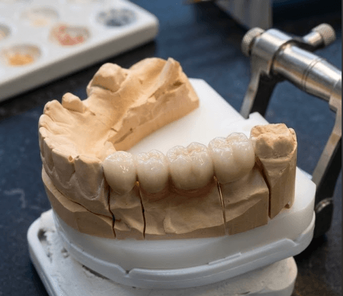 Crowns fitted on a stone model mounted in an articulator