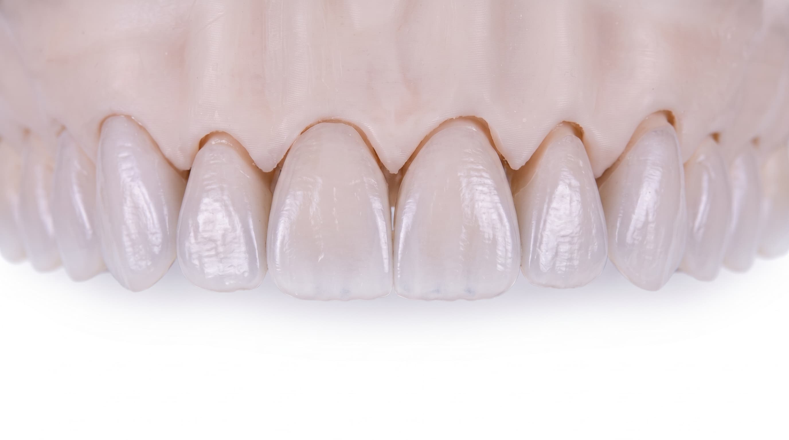 A row of ceramic veneers on the upper front teeth of a dental model