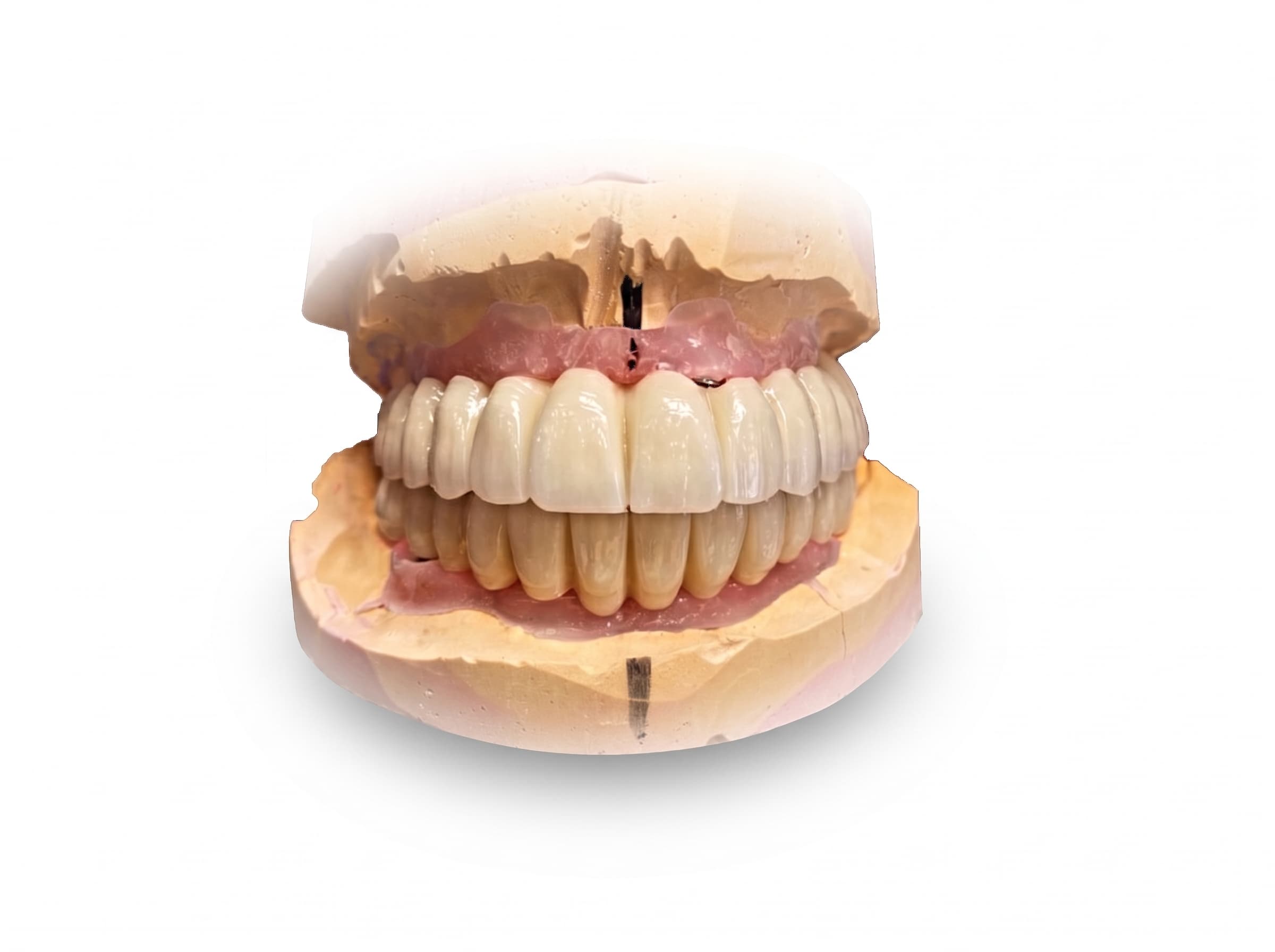 Full-arch porcelain teeth on a dental model