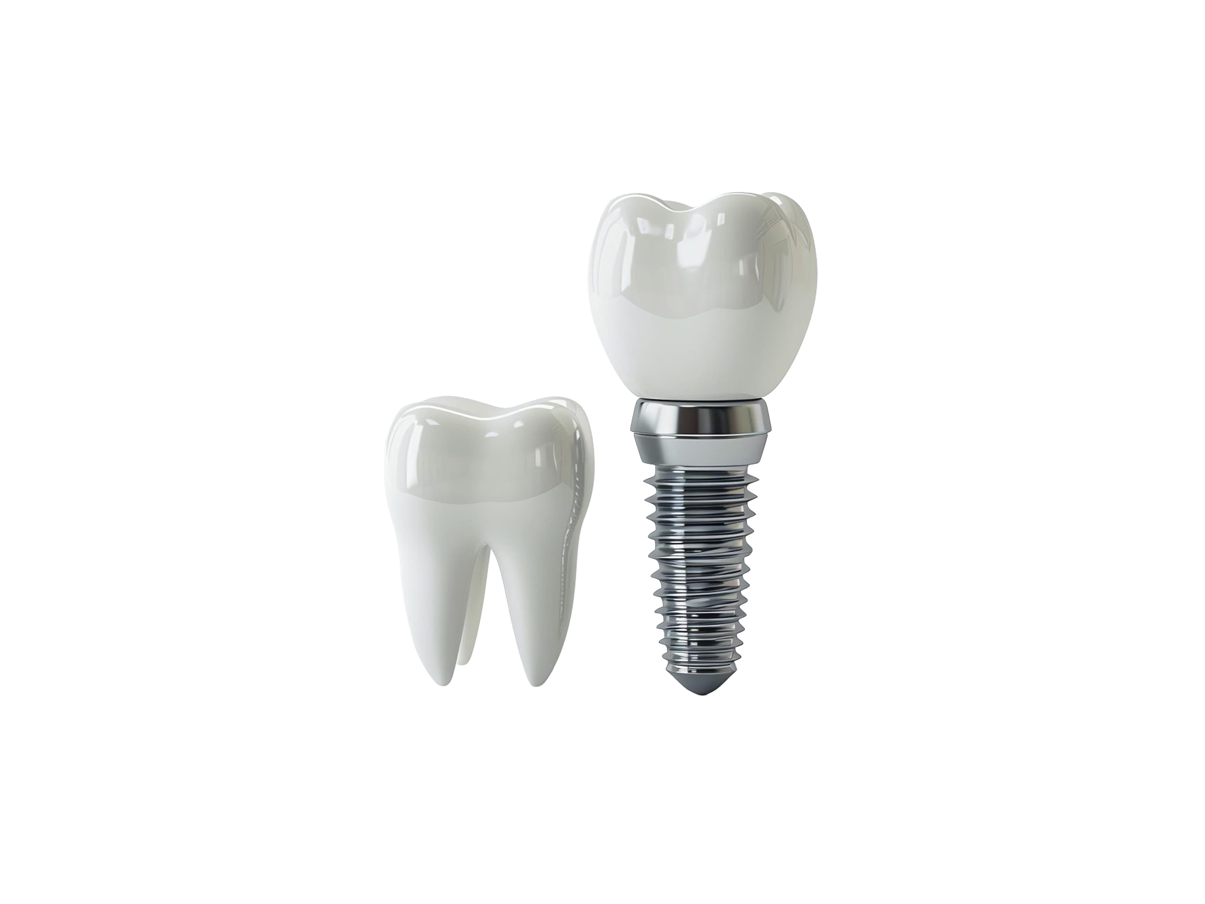 A dental implant with its crown next to a natural tooth model